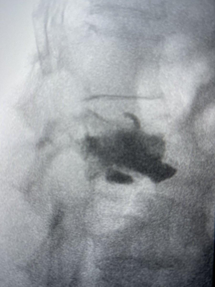 darthglader's tweet photo. The balloon inflates in the midline. Then reach #fillgoals with cement. Good fill of the fracture line, with a titch in the superior endplate and through the inferior endplate.

Patient had complete resolution of her back pain for the first time in weeks. 

#MSKIRFTW https://t.co/d6bsbv8jaS