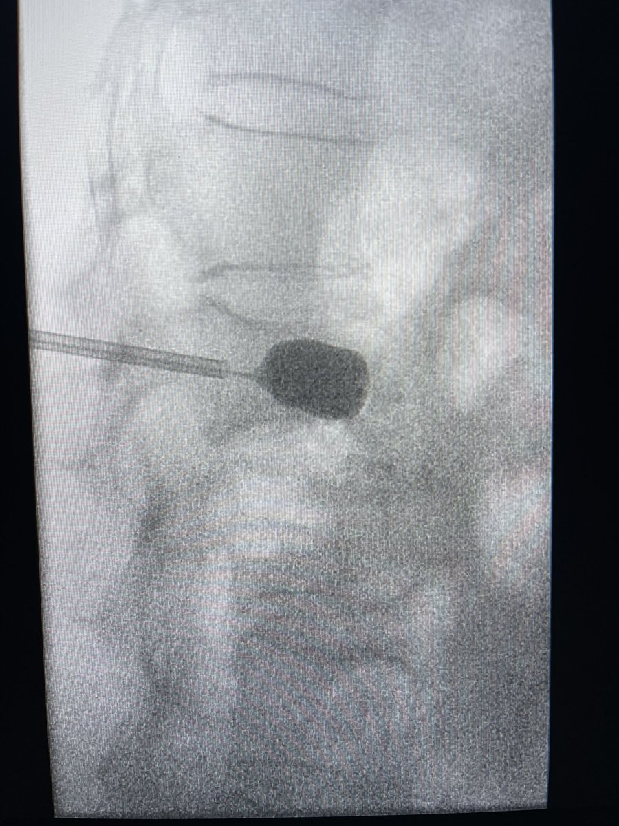 darthglader's tweet photo. The balloon inflates in the midline. Then reach #fillgoals with cement. Good fill of the fracture line, with a titch in the superior endplate and through the inferior endplate.

Patient had complete resolution of her back pain for the first time in weeks. 

#MSKIRFTW https://t.co/d6bsbv8jaS