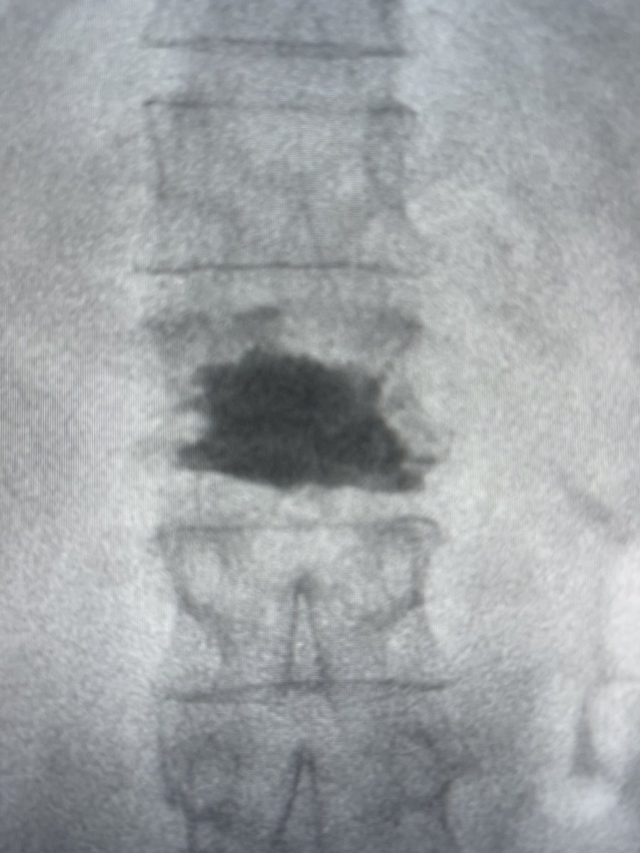 darthglader's tweet photo. The balloon inflates in the midline. Then reach #fillgoals with cement. Good fill of the fracture line, with a titch in the superior endplate and through the inferior endplate.

Patient had complete resolution of her back pain for the first time in weeks. 

#MSKIRFTW https://t.co/d6bsbv8jaS