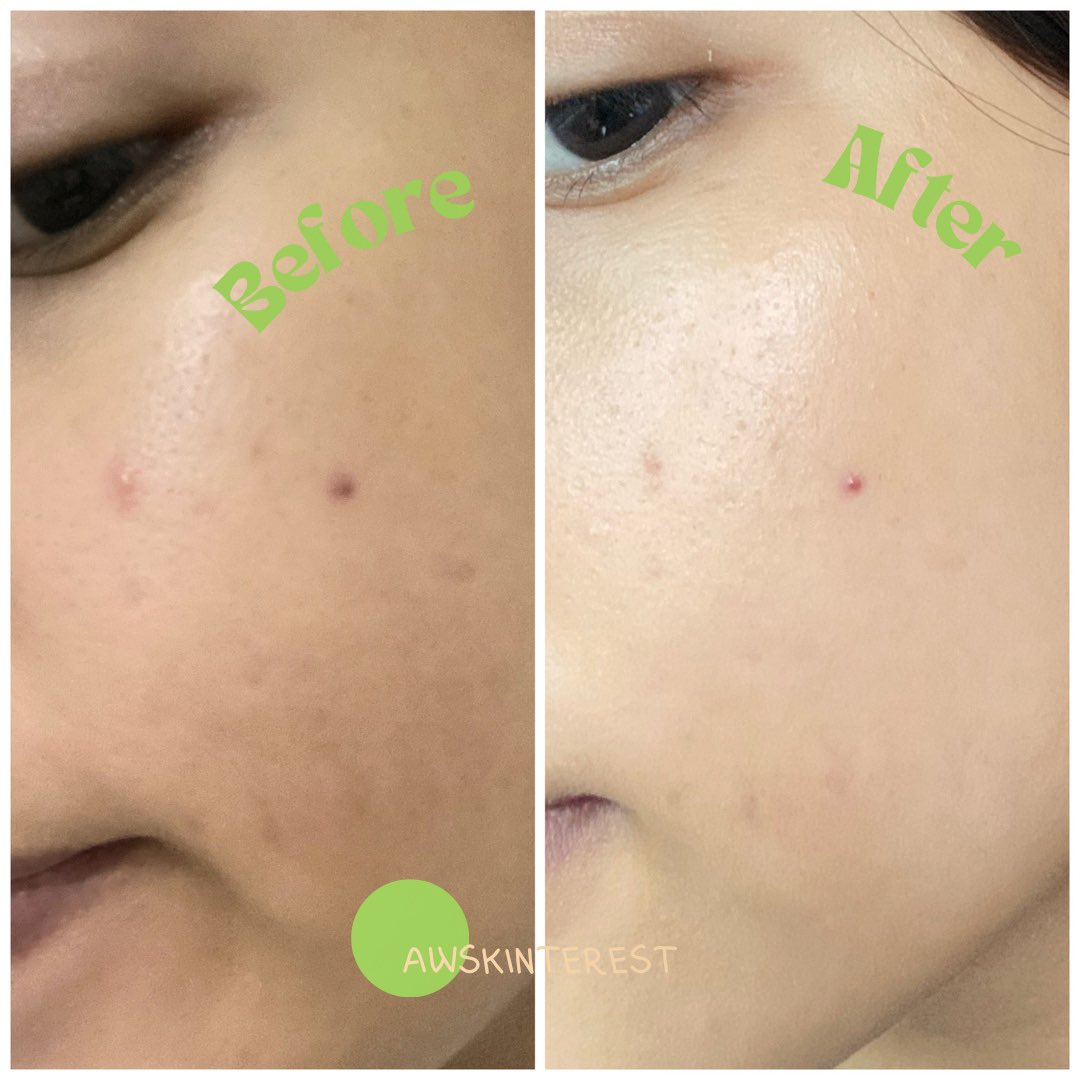 awskinterest's tweet photo. PEELING 60 DETIK ANTI CLEKIT-CLEKIT
ELFORMULA INTENSIVE PEELING SOLUTION
#peelingsolution #elformula #racuninskincare https://t.co/8ewnmn645Z