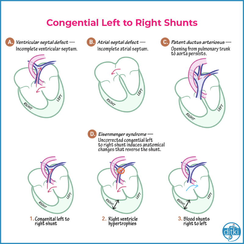 InnovCardio's tweet photo. Learn more about these shunts
Credit: @drawittoknowit

#MedEd  #medschool #MedStudentTwitter   #cardiovascular  #pathology #heartshunts #Nursing  #pance #physicianassistant #osteopath #allopath #medicine #science #healthscience #nurse #premed https://t.co/oBlEZguVek