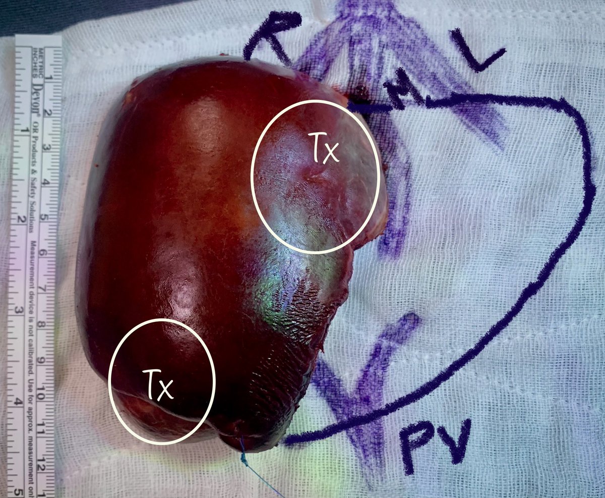Did Rt hepat. &amp; shaved off seg IV tumor from MHV. CUSA is a magical wand :)

Discharged on D4 with normal LFT’s &amp; intact MHV+LHV

Histo; -ve margins (&gt;2 mm)

Planned for 2 more cycles of chemo

<a href="/IHPBA/">IHPBA</a> <a href="/HpbLounge/">HPB Lounge</a> <a href="/hpb_so/">SoMe4HPB</a> #MedTwitter #MedEd #livertwitter #Cancer