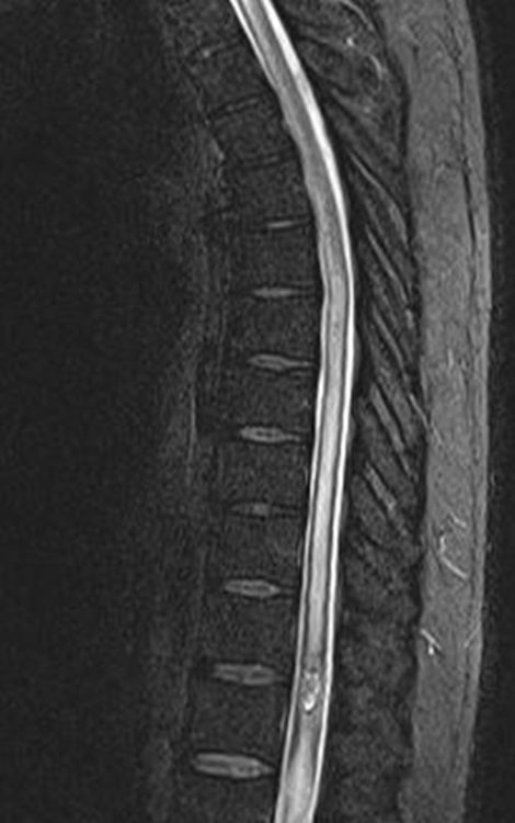 TheAJNR's tweet photo. #AJNRcow >> December 29, 2022 >> A 45-year-old man with a history of renal cell carcinoma presents with subacute onset of asymmetric flaccid paraparesis with signs of pyramidal tract dysfunction, a sensory level at L2, and urinary retention. View the case: https://t.co/L4YqRI7OjN https://t.co/vVY9Zs8zKm