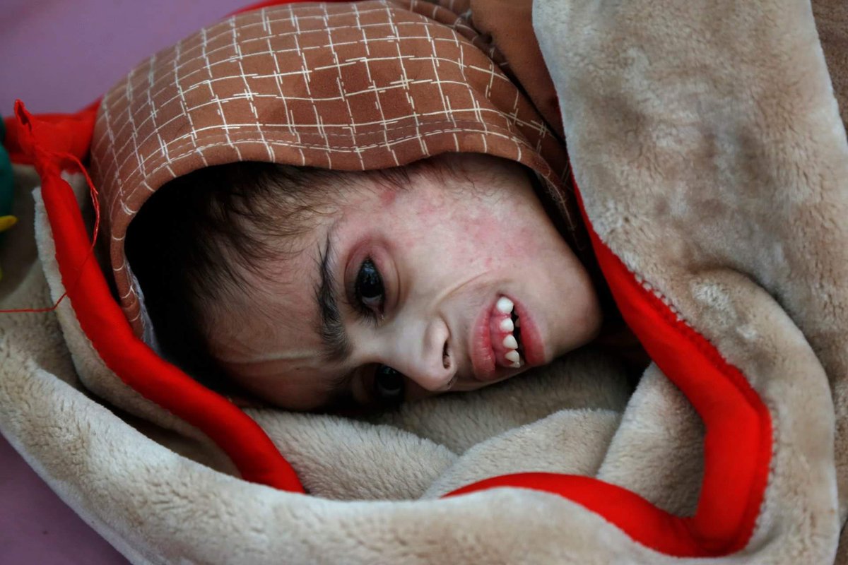 MagdalenaGaza's tweet photo. #FaidSamim, one of the faces of the #starvation in #Yemen 🇾🇪 He was only #7kilos. More than #2million #children are #acutelymalnourished and are #starving to death. https://t.co/TPhLjut28O