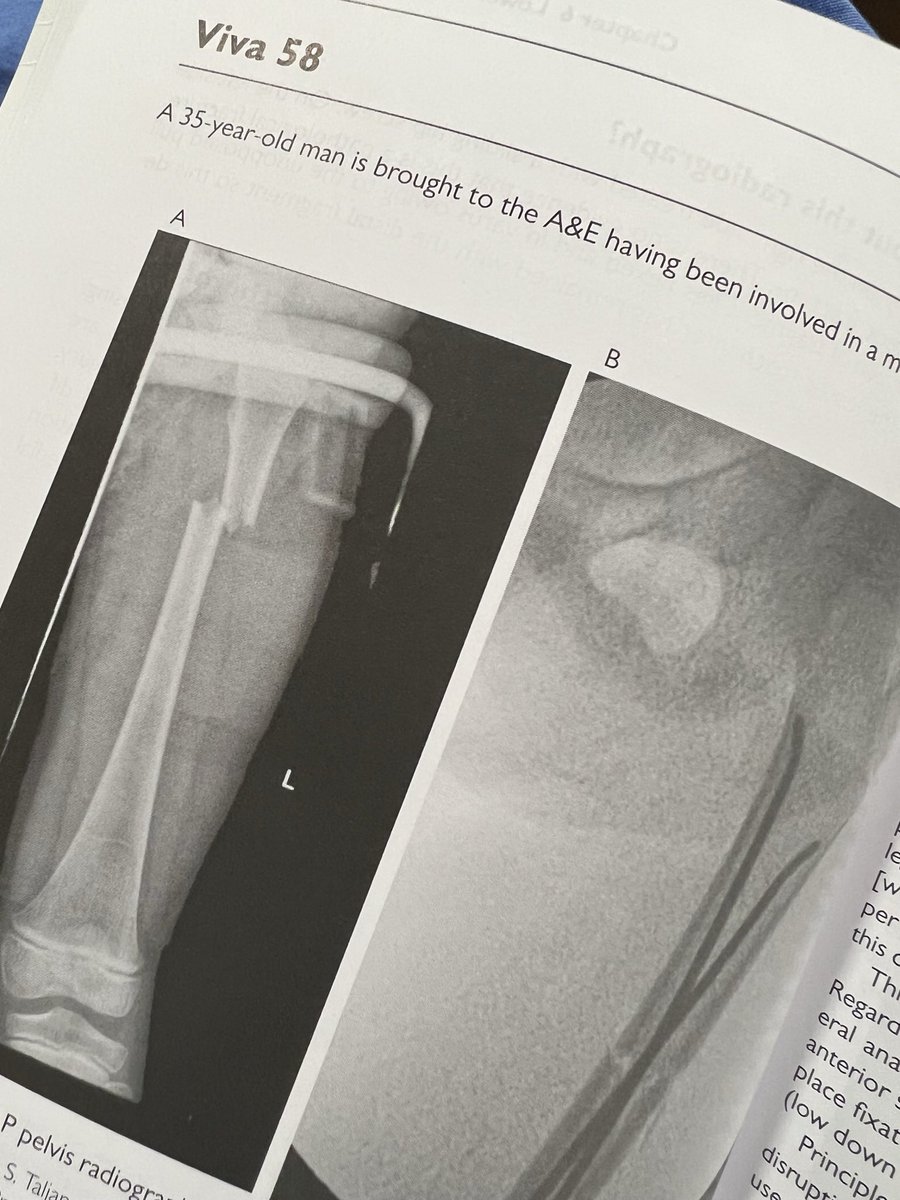 OrthopodReg's tweet photo. Spot diagnosis 

This patient is not 35. Inappropriate referral. Bye. 

*drops mic and walks out of viva*

#orthotwitter https://t.co/P57TpfH5zK