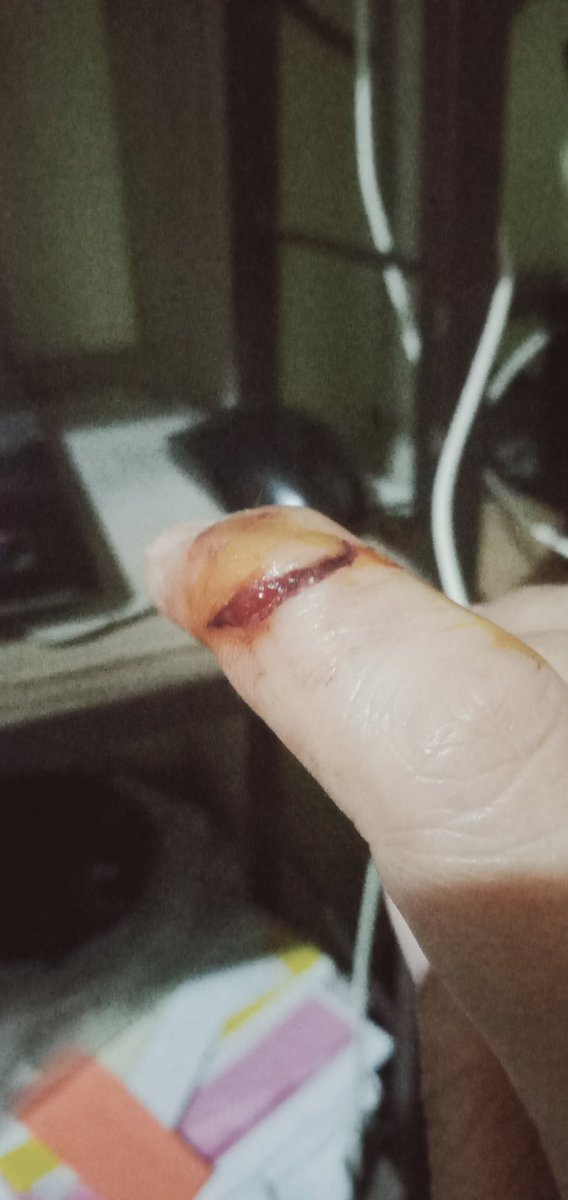 chocho0725's tweet photo. Hindi nga naputukan ng labentador, sa lata nman nadisgrasya😢 https://t.co/7GpjwbNlSs