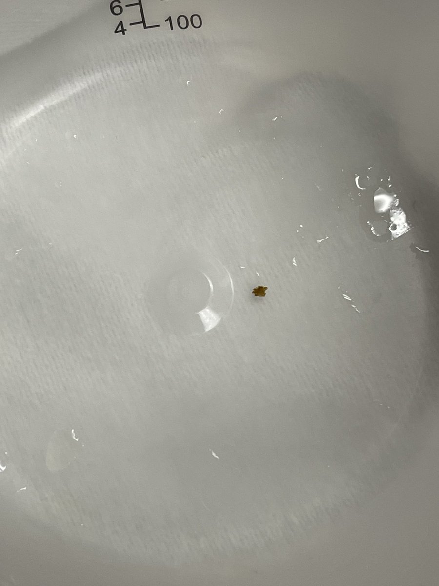 Erin On Twitter I Passed A 4 5mm Kidney Stone Today My Left erin-on-twitter-i-passed-a-4-5mm-kidney-stone-today-my-left