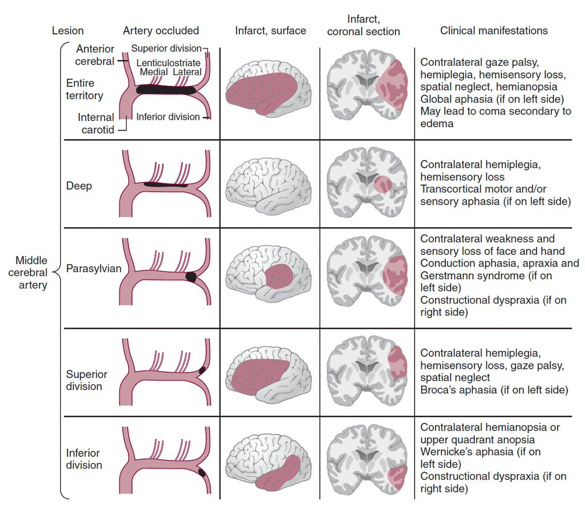 ⭕️MCA occlusions / 🧠 infarct patterns

Maybe time for this👇again <a href="/MicieliA_MD/">Andrew Micieli</a>?

#MedTwitter #MedStudentTwitter #MedEd #FOAMed
#neurotwitter #Neurology #stroke #Neurosurgery  #EndNeurophobia #FOAMrad #NeuroRad #neuroradiology #radiology #radres #RadEd #FOAMncc #MRI