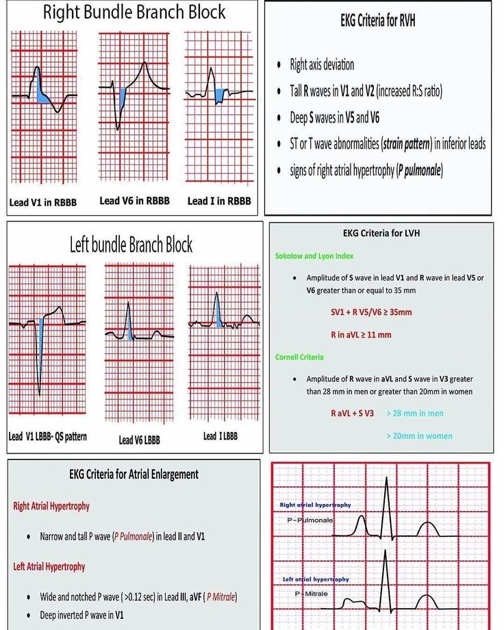 medictests's tweet photo. Quick Reference: Bundle Branch Blocks and Hypertrophy https://t.co/BJlpDGjGnY
