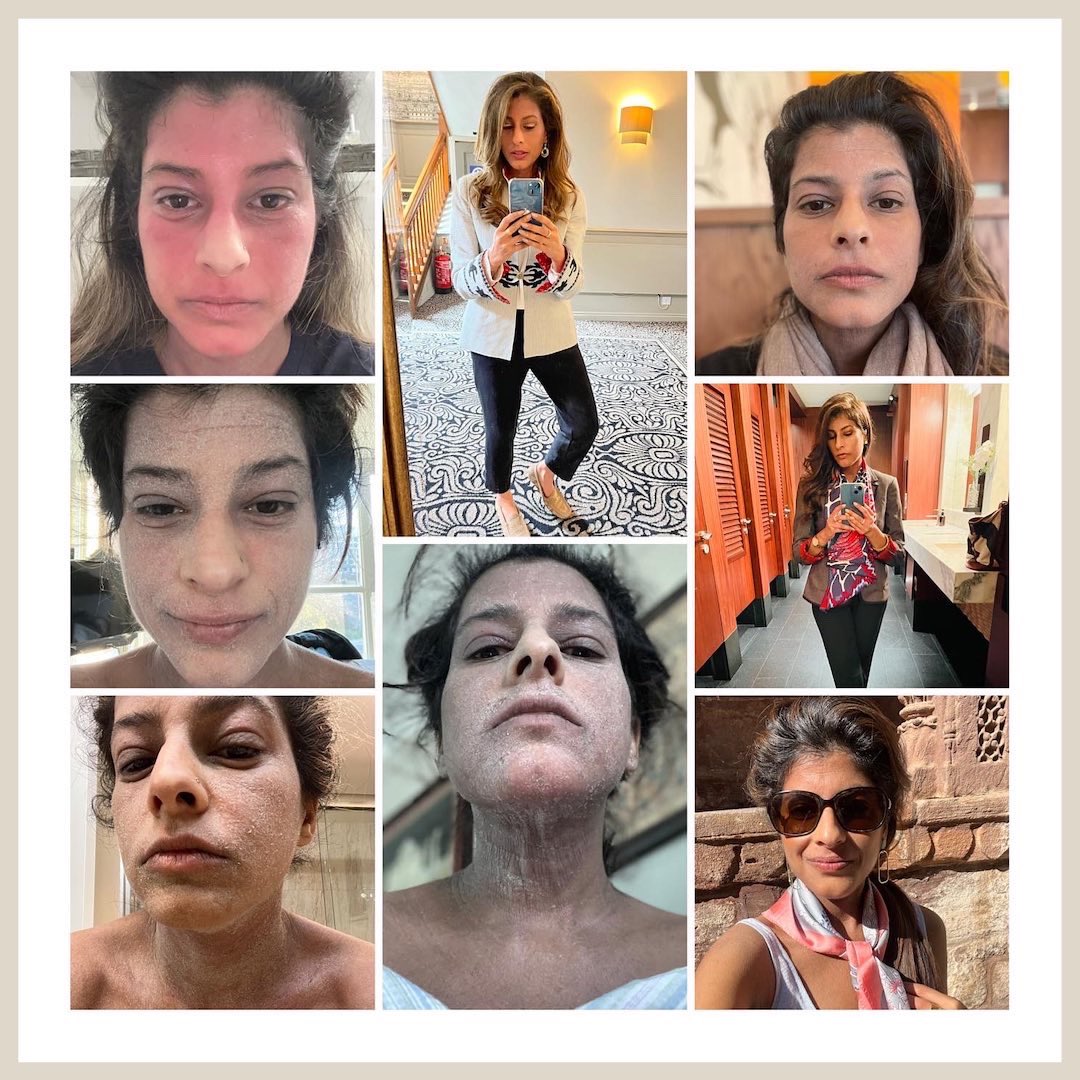It’s been a hard 2022, but I’m conquering #topicalsteroidwithdrawal using #Ayurveda therapies in India. I had to resign from my job  <a href="/amazonca/">Amazon Canada</a> &amp; invest in health healing. Be kind to yourself. Life is fun &amp; funky. Find blessings hurdles &amp; take the hard path 🙌. #HappyNewYear