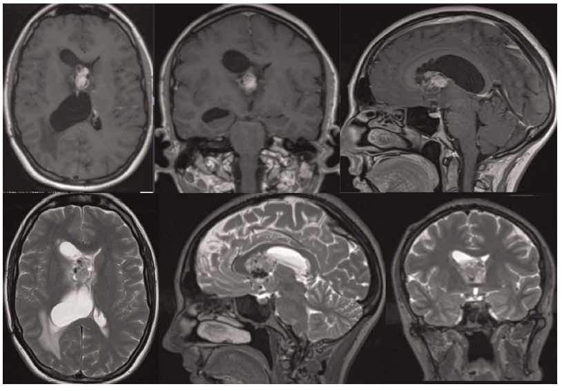 KingsNeuro's tweet photo. Happy New Year from team @KingsNeuro. Publication to start the new year:
"Photodynamics of Subependymal Giant Cell Astrocytoma with 5-Aminolevulinic acid"
Read more: https://t.co/B5s5py3BA6
👏💪@PrazNeuro @lavrador_jose @Sabzp87 https://t.co/0YjUJzRuO7
