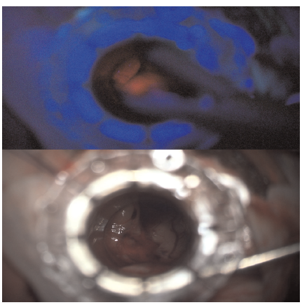 KingsNeuro's tweet photo. Happy New Year from team @KingsNeuro. Publication to start the new year:
"Photodynamics of Subependymal Giant Cell Astrocytoma with 5-Aminolevulinic acid"
Read more: https://t.co/B5s5py3BA6
👏💪@PrazNeuro @lavrador_jose @Sabzp87 https://t.co/0YjUJzRuO7