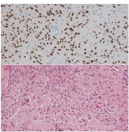 KingsNeuro's tweet photo. Happy New Year from team @KingsNeuro. Publication to start the new year:
"Photodynamics of Subependymal Giant Cell Astrocytoma with 5-Aminolevulinic acid"
Read more: https://t.co/B5s5py3BA6
👏💪@PrazNeuro @lavrador_jose @Sabzp87 https://t.co/0YjUJzRuO7
