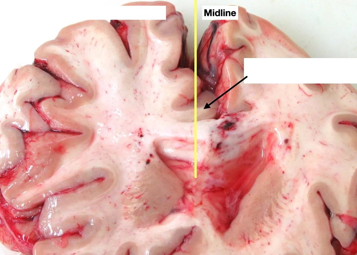 kiko4docs's tweet image. Coronal section of brain shared by @WKemp_MT_FPDoc. 
The arrow shows what finding? 
Answer &amp;amp; labels: kikoxp.com/posts/8903
More about Dr. Kemp on his Kiko profile: kikoxp.com/walter_kemp3
#autopsy #grosspath #neuropath #forensics #pathology #pathTwitter