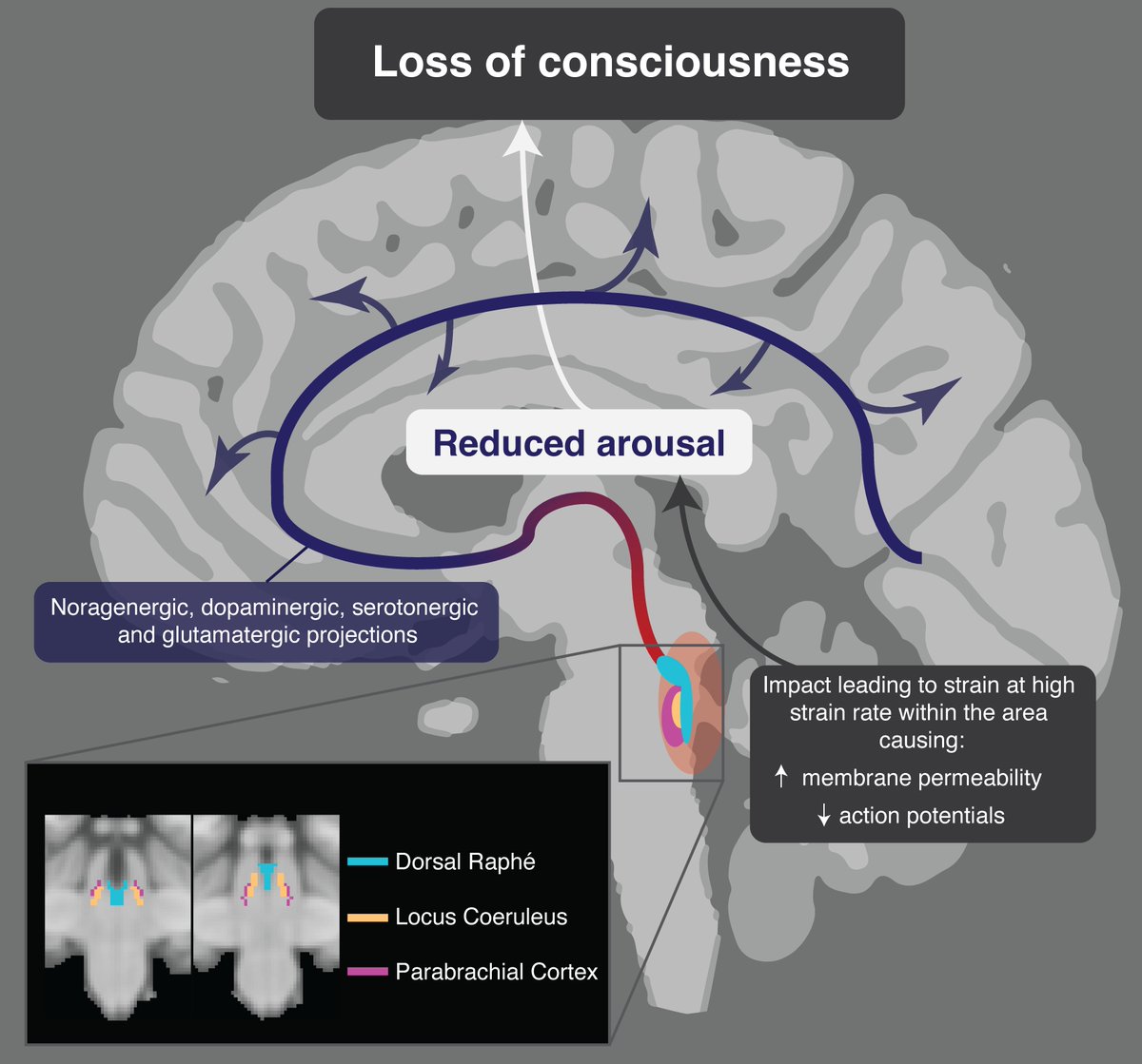 By analysing videos of concussions in professional American football games and modelling the impacts, Zimmerman et al. identify a biomechanical signature associated with loss of consciousness. bit.ly/3IaW6Bc
