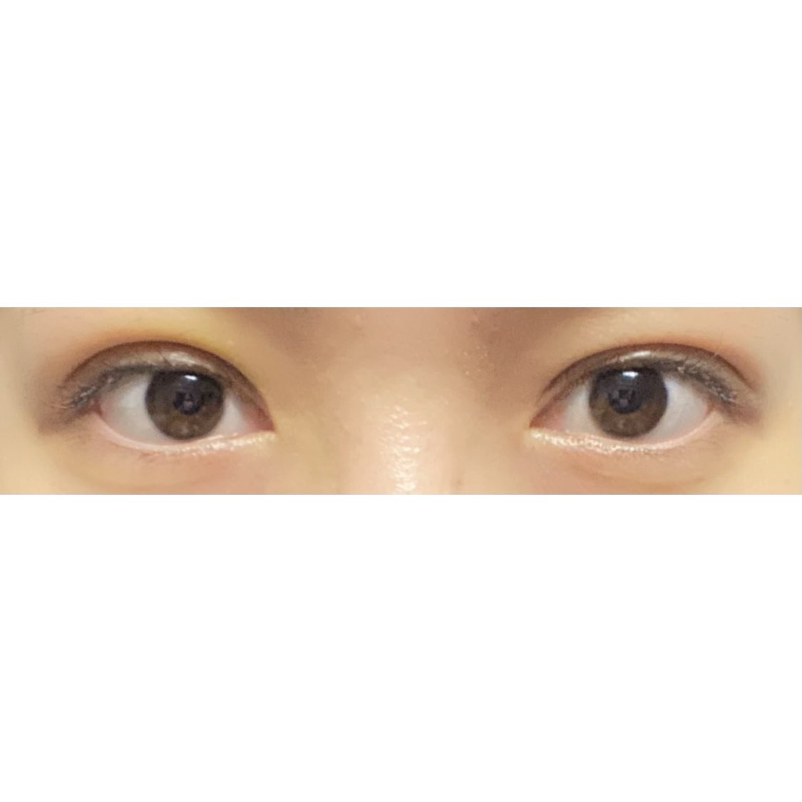8_axuw's tweet photo. 湘南美容クリニック池袋東口院
赤尾先生指名
クイックコスメティークトリプルNeo
術後4日目📸

#二重整形 #埋没法 #整形 #美容 #美容整形 #二重 #クイックコスメティークトリプルNeo https://t.co/TjFYdUPzvp