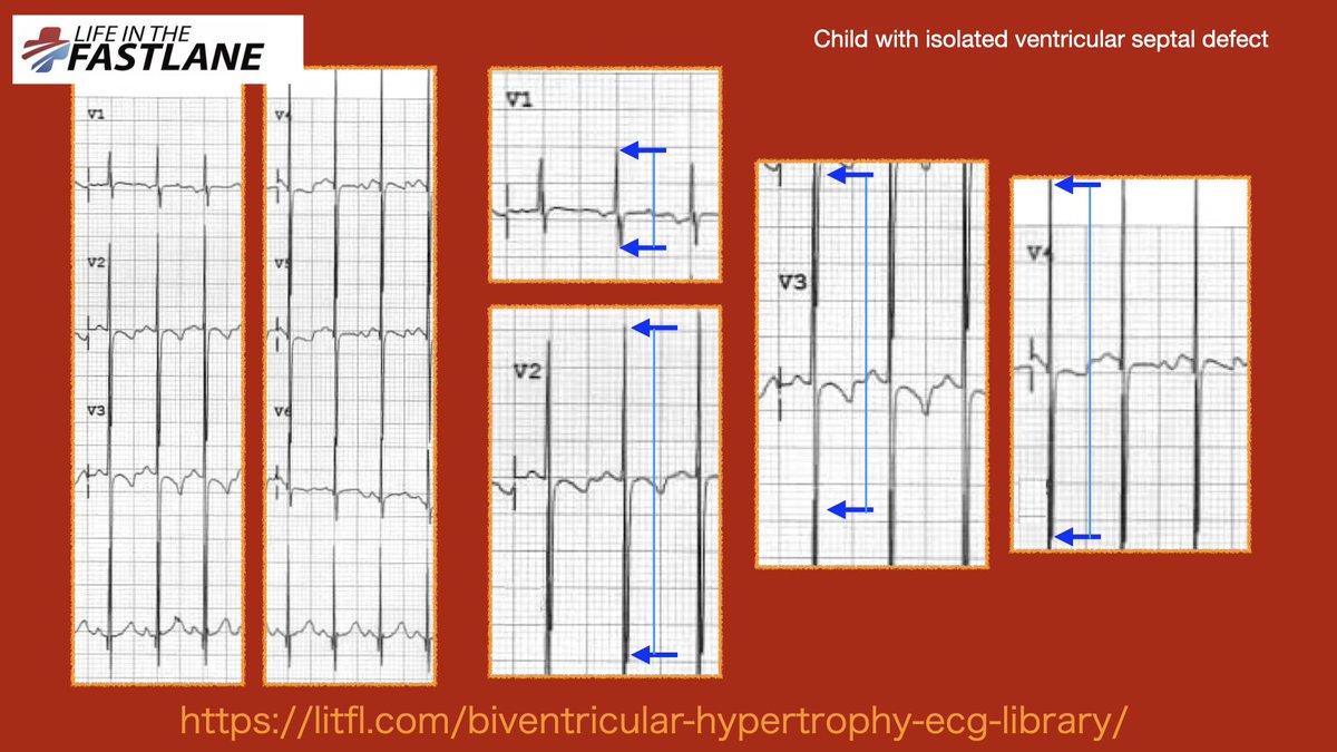 N. Tsukishima EP大学心電図検定学部試験対策科担任 on Twitter "心電図検定試験の小児心電図 06 ＊両室肥大‼️