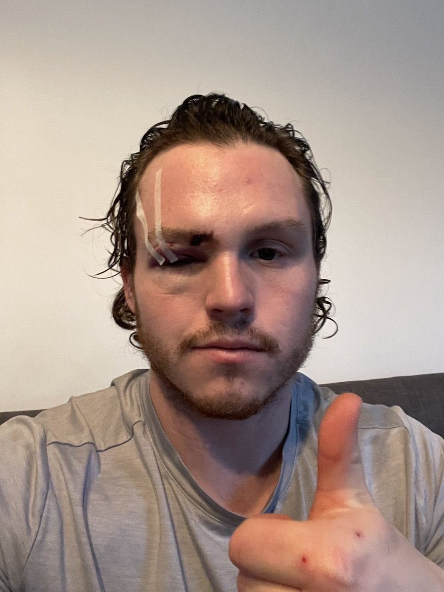 Thanks purple army for all the messages! All is good! Thankful as it could of been much worse. Thanks to the docs and our physio Kirsty for fixing me up! Grateful to still have both my 👀’S