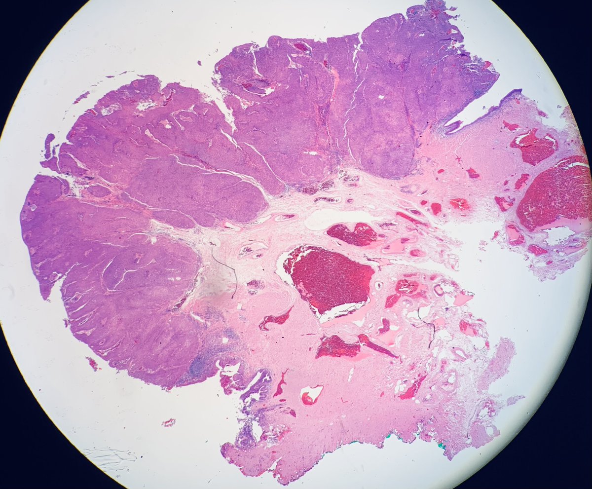 Jerad Gardner, MD on Twitter "RT HENRYY_MD Anorectal Basaloid