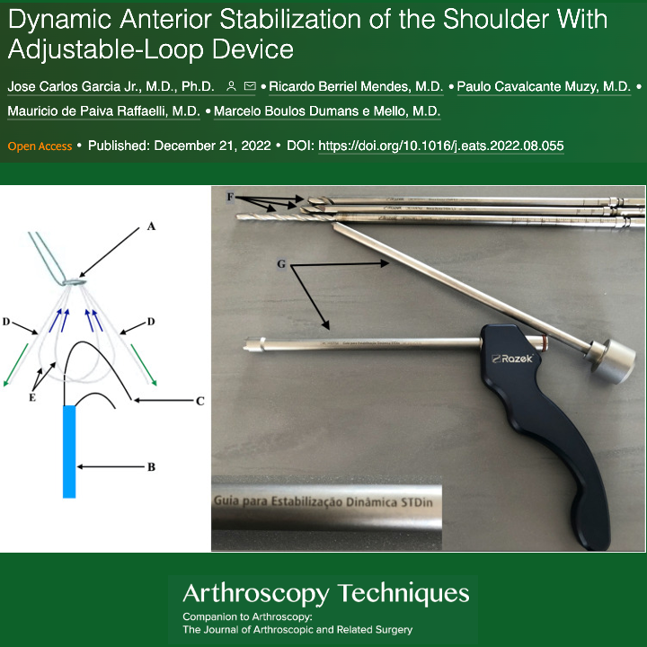 ArthroscopyJ's tweet image. Dynamic Anterior Stabilization of the Shoulder With Adjustable-Loop Device #shoulder #stabilization arthroscopytechniques.org/article/S2212-…
