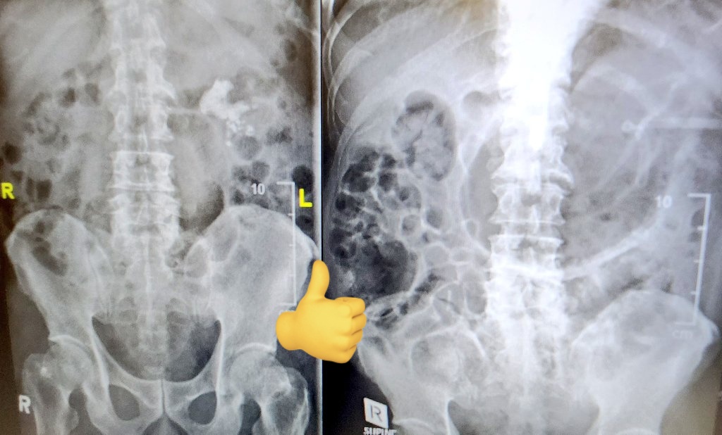 DocGauhar's tweet photo. Best of 2 🌎
OLD:prone/bulls eye/serial dilatation UP supracostal saves the day with just 1 24fr acess
NEW: @OlympusUrology #Shockpulse + #Nephroscopy
@PETRAurogroup
@PEARLSendouro
#personalisedstoneapproach @OstherPalle @endouro @scoffonecesare @KStoneAcademy @endouroacademy https://t.co/y01OxYKJ0u