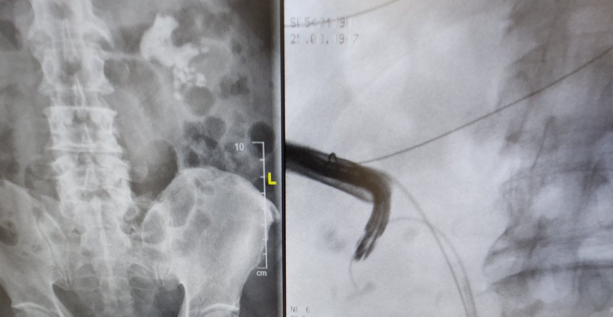 DocGauhar's tweet photo. Best of 2 🌎
OLD:prone/bulls eye/serial dilatation UP supracostal saves the day with just 1 24fr acess
NEW: @OlympusUrology #Shockpulse + #Nephroscopy
@PETRAurogroup
@PEARLSendouro
#personalisedstoneapproach @OstherPalle @endouro @scoffonecesare @KStoneAcademy @endouroacademy https://t.co/y01OxYKJ0u