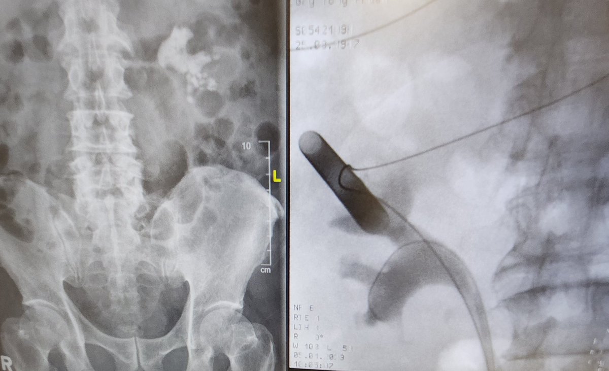 DocGauhar's tweet photo. Best of 2 🌎
OLD:prone/bulls eye/serial dilatation UP supracostal saves the day with just 1 24fr acess
NEW: @OlympusUrology #Shockpulse + #Nephroscopy
@PETRAurogroup
@PEARLSendouro
#personalisedstoneapproach @OstherPalle @endouro @scoffonecesare @KStoneAcademy @endouroacademy https://t.co/y01OxYKJ0u