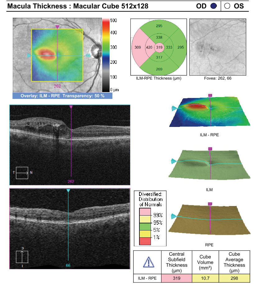 DME Patients with Thinner Choroids Respond Better to Anti-VEGF 💉 
These individuals also needed fewer injections, study finds.
reviewofoptometry.com/article/dme-pa…
#dme #retina #optometry #diabeticmacularedema