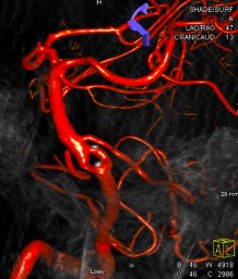 Excited to report a case of vertebro-basilar junction aneurysm successfully treated with WEB device
<a href="/KunalVakhariaMD/">Kunal Vakharia</a> <a href="/cvsection/">CV Section</a> <a href="/SNISinfo/">SNIS Info</a> <a href="/svinsociety/">SVIN</a> <a href="/YoungNIR/">YoungNIR</a>  doi.org/10.1016/j.hest…