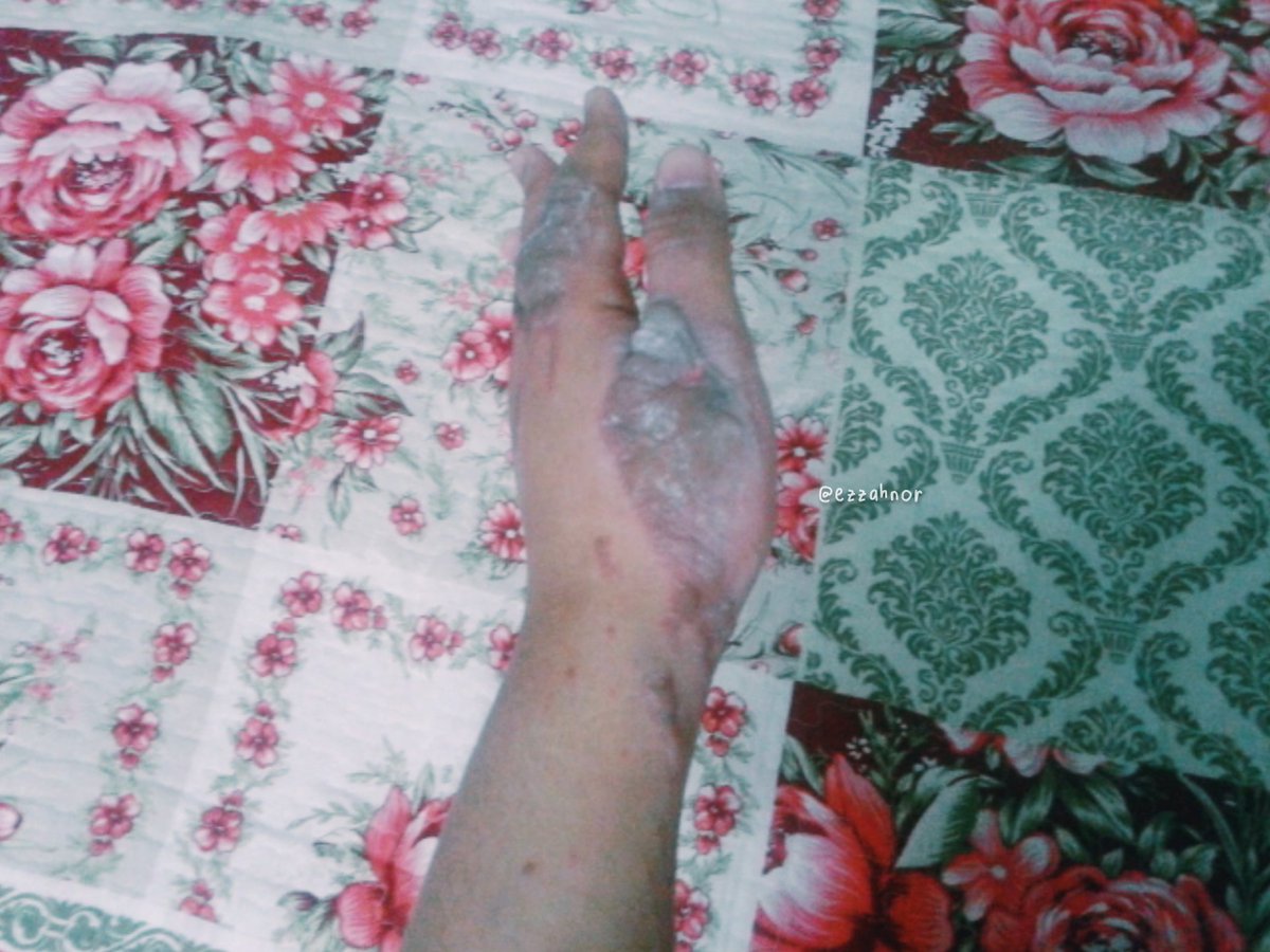 ezzahnor's tweet photo. Tangan i pernah melecur teruk gila. 

Ingatkan parut akan kekal sampai bila2 tapi nasib baik makin ok 😭

Meh i share i guna cream apa &amp; berapa lama baru parut i boleh hilang. https://t.co/JN9QJDjfDq