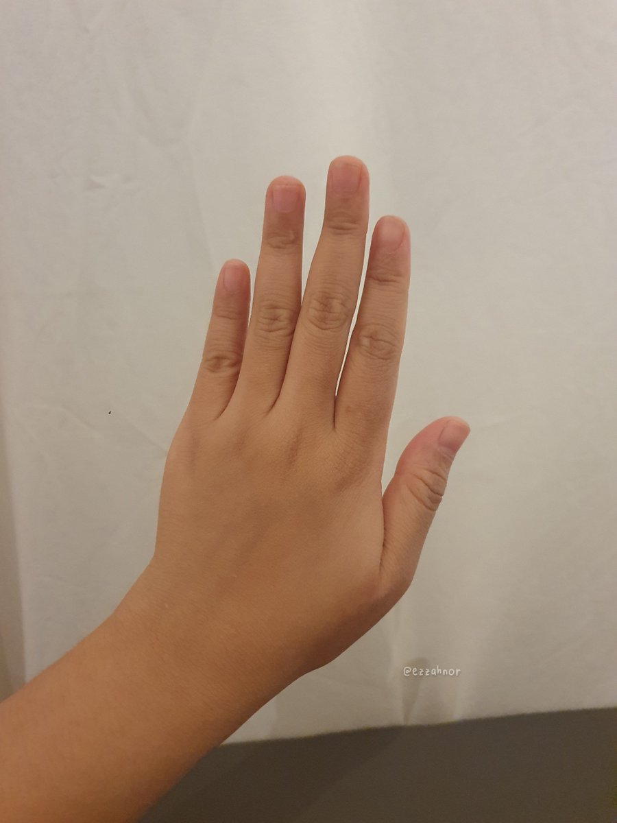 ezzahnor's tweet photo. Tangan i pernah melecur teruk gila. 

Ingatkan parut akan kekal sampai bila2 tapi nasib baik makin ok 😭

Meh i share i guna cream apa &amp; berapa lama baru parut i boleh hilang. https://t.co/JN9QJDjfDq