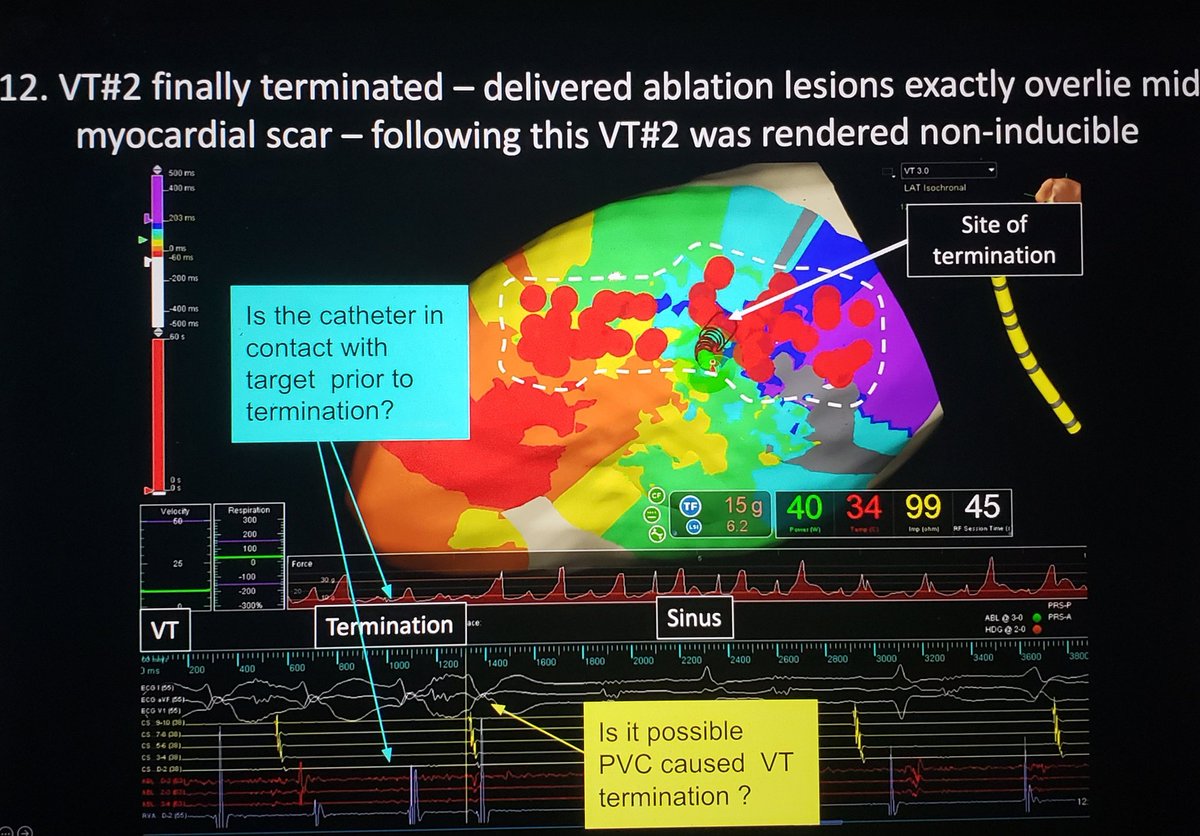 SchakrabartiEP's tweet photo. @ericlim1975 Very nice , would you please help me understand VT 2 termination? https://t.co/scOCeaJkWz