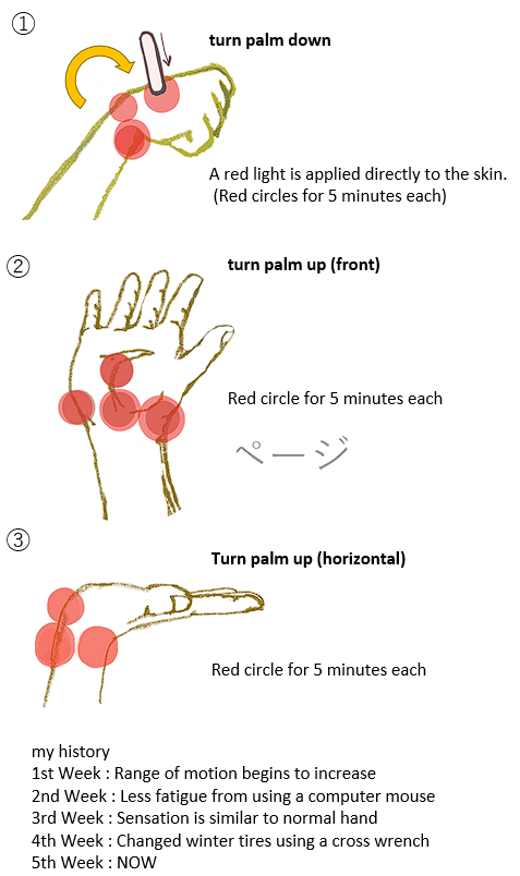 simasimaxp3's tweet photo. I used a $15 red light selling home improvement store for 5 weeks for Keenbock disease.
My Kienbok disease was treated conservatively.
#carpal bones
#carpal's disease
#keenbock
#Kienbock's disease
#red light therapy https://t.co/nHgkKke7I0