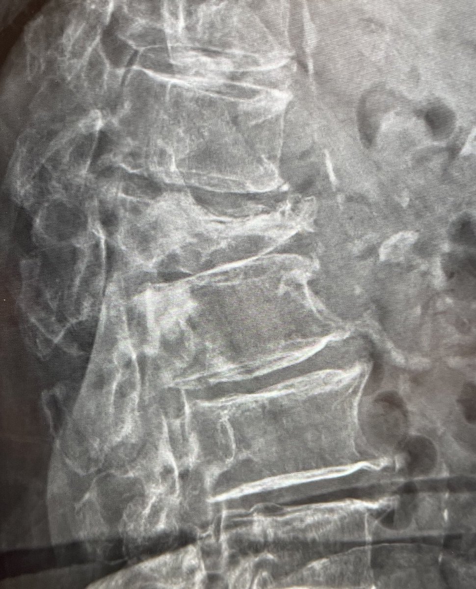 darthglader's tweet photo. More #MSKIR in an elderly woman with mild dementia who has had multiple falls over the last several months. An X-ray revealed a #compressionfracture of uncertain age. She couldn’t tolerate #MRI. A #bonescan showed high uptake in the collapsed vertebra. (And rib fractures). https://t.co/aLChqoaU2M