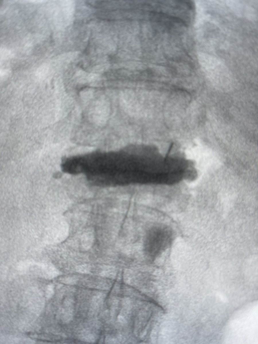 darthglader's tweet photo. I withdrew the balloon and introducer slightly, then did another inflation with my assistant inflating the ballon and with me providing back pressure on the balloon catheter to keep it from slipping forward into the cavity. Then, #fillgoals with 16 mL of cement injected. https://t.co/36xB5GNw6E