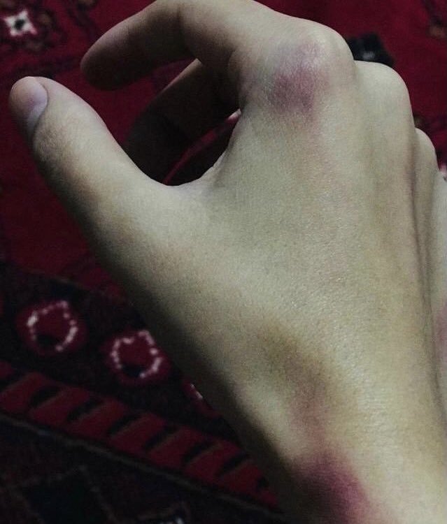 mortazabehboudi's tweet photo. ❌ Une amie journaliste afghane a été fouettée gravement par les talibans alors qu’elle réalisait un reportage à Kaboul. Elle a été emmenée au commissariat et a été menacée de mort si elle continue à travailler en tant que journaliste. @RSF_inter @RSF_fr ? https://t.co/bbDI9p24Rn