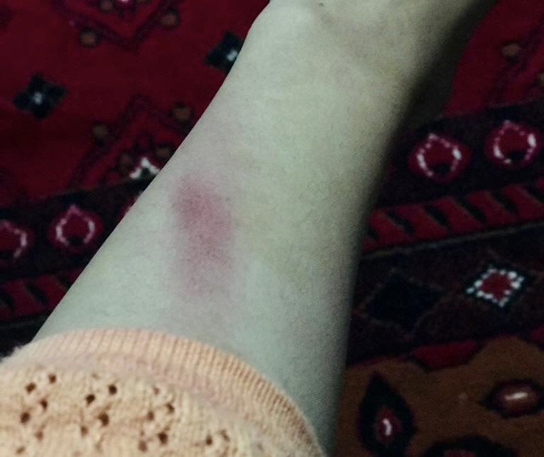 mortazabehboudi's tweet photo. ❌ Une amie journaliste afghane a été fouettée gravement par les talibans alors qu’elle réalisait un reportage à Kaboul. Elle a été emmenée au commissariat et a été menacée de mort si elle continue à travailler en tant que journaliste. @RSF_inter @RSF_fr ? https://t.co/bbDI9p24Rn