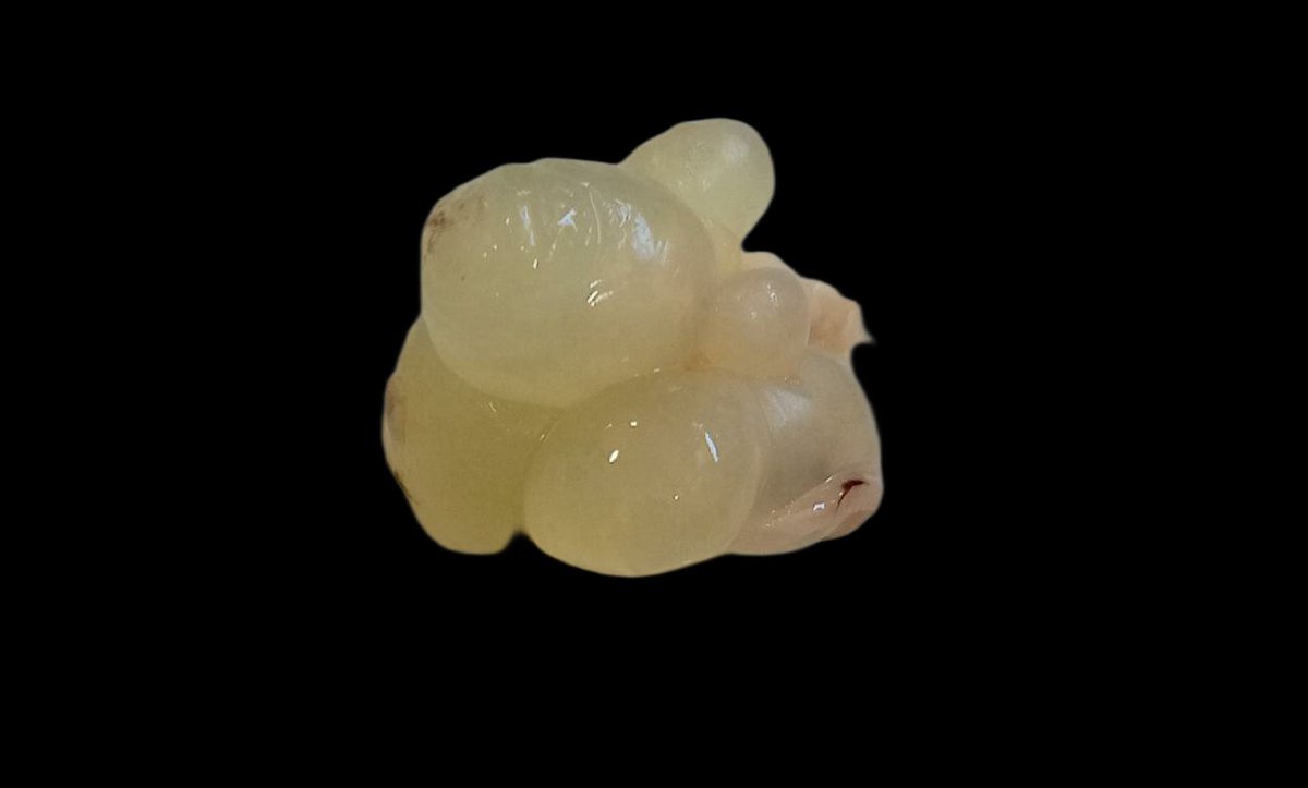 Swathiprabhu5's tweet photo. Paratubal cyst . Gross and microscopy
Largest cyst was around 1 cm in diameter
#histopathology #pathologists #pathology #FGTpath https://t.co/BonIe8zqs8