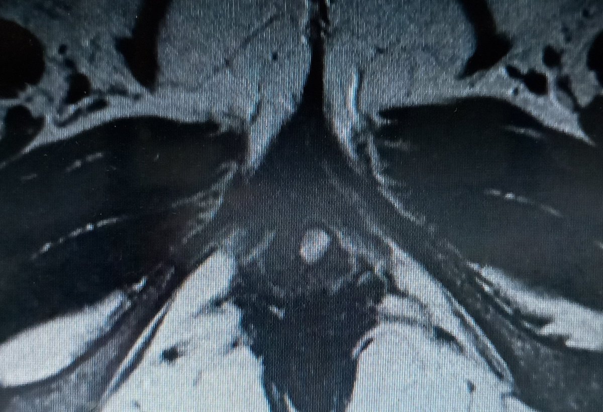 Never underestimate a female urethral diverticulum, 1 cm diverticulum, nearly 1 year recurrent febrile UTI and dysparunia, 3 months after surgical removal completely asymptomatic