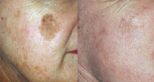 QuipDerma's tweet photo. Normal skin has a fine even texture with a supple and smooth surface. It has a proper balance between oil and moisture contents and is therefore moist and is neither greasy or dry. The pores of normal skin are small and the overall skin tone is even with the Facial Skin Analysis. https://t.co/JnmXNBBmDl