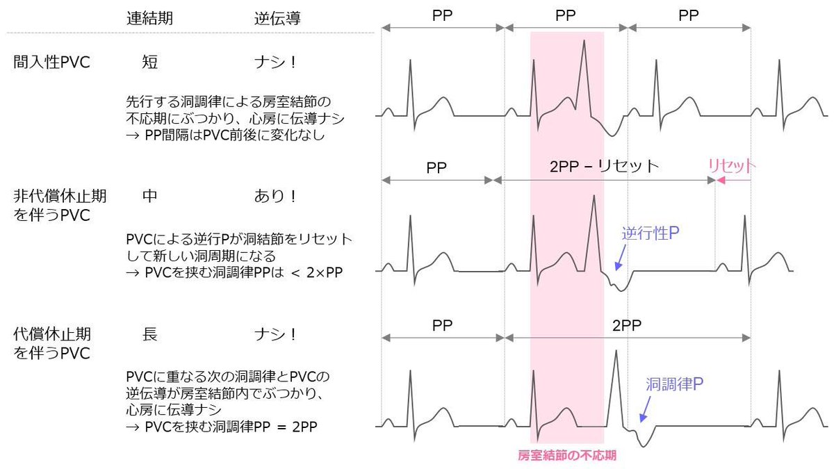 Koichi16423232's tweet photo. 今年はPVC年😃

PVCでまず評価する…間入性、代償休止期、非代償休止期…
ココ超覚えにくくないっすか💦

❤️‍🔥覚えるコツ❤️‍🔥
1. 先行する洞調律とPVCの連結期が
短→中→長
で名前が決まる！

2. 連結期が短すぎ(間入性)
or 長すぎ(代償性)、逆伝できないと、PVCは心室のみの出来事で心房に影響ナシ❤️‍🔥

続 https://t.co/hI36T6IqdJ
