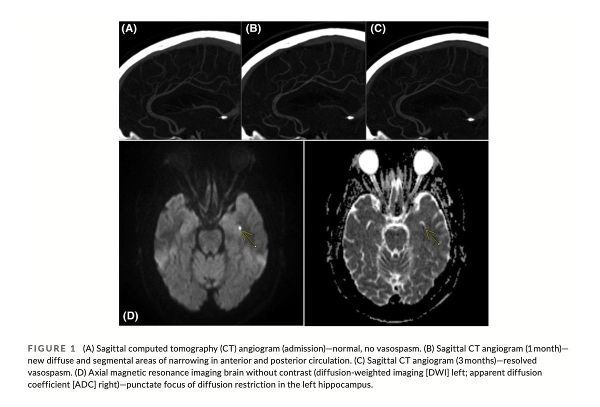 Free Access:
The link between #ReversibleCerebralVasoconstrictionSyndrome (#RCVS) &amp; #TransientGlobalAmnesia (#TGA)
<a href="/RahulcVasNeuro/">Rahul Chandra, MD</a> Harneel Singh Saini, <a href="/kaitlyn_palmer1/">Kaitlyn Palmer</a> Russell Cerejo, <a href="/AHNtoday/">AHN</a> <a href="/CLENeurons/">Cleveland Clinic Neurology Residents</a> <a href="/CleClinicMD/">Cleveland Clinic MD</a> 

…adachejournal.onlinelibrary.wiley.com/doi/full/10.11…