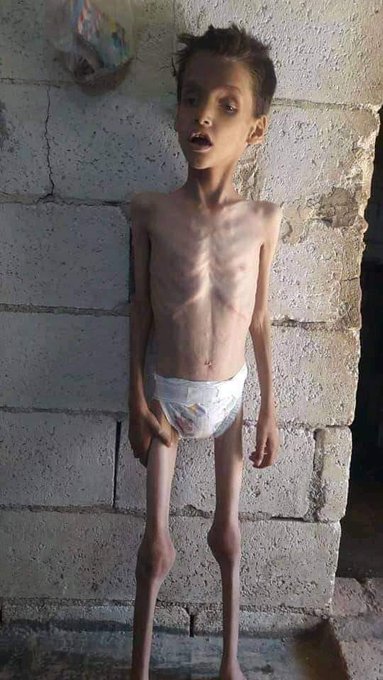 Would you #help provide crucial food aid to the hungry in #Yemen? 

Donate today at gogetfunding.com/emergency-appe…