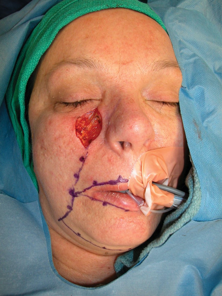 Trending in PRS: Useful Flaps for Plastic Surgeons to Know dlvr.it/SgGKlB #plasticsurgery #PRSJournal