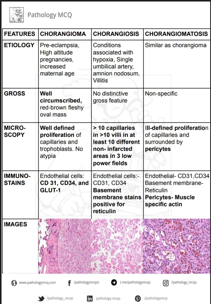 Pathology_mcqs's tweet photo. Chorangioma, chorangiosis and chorangiomatosis does sound similar right? Find out the differences. #placentalpathology #pathtwitter #pathsummaries #pathboards #pathology #fgtpath #pathresident #pathresidents #frcpathpart1 #neetssoncopathology #histopathology #chorangiosis https://t.co/vJTxnR59Ri
