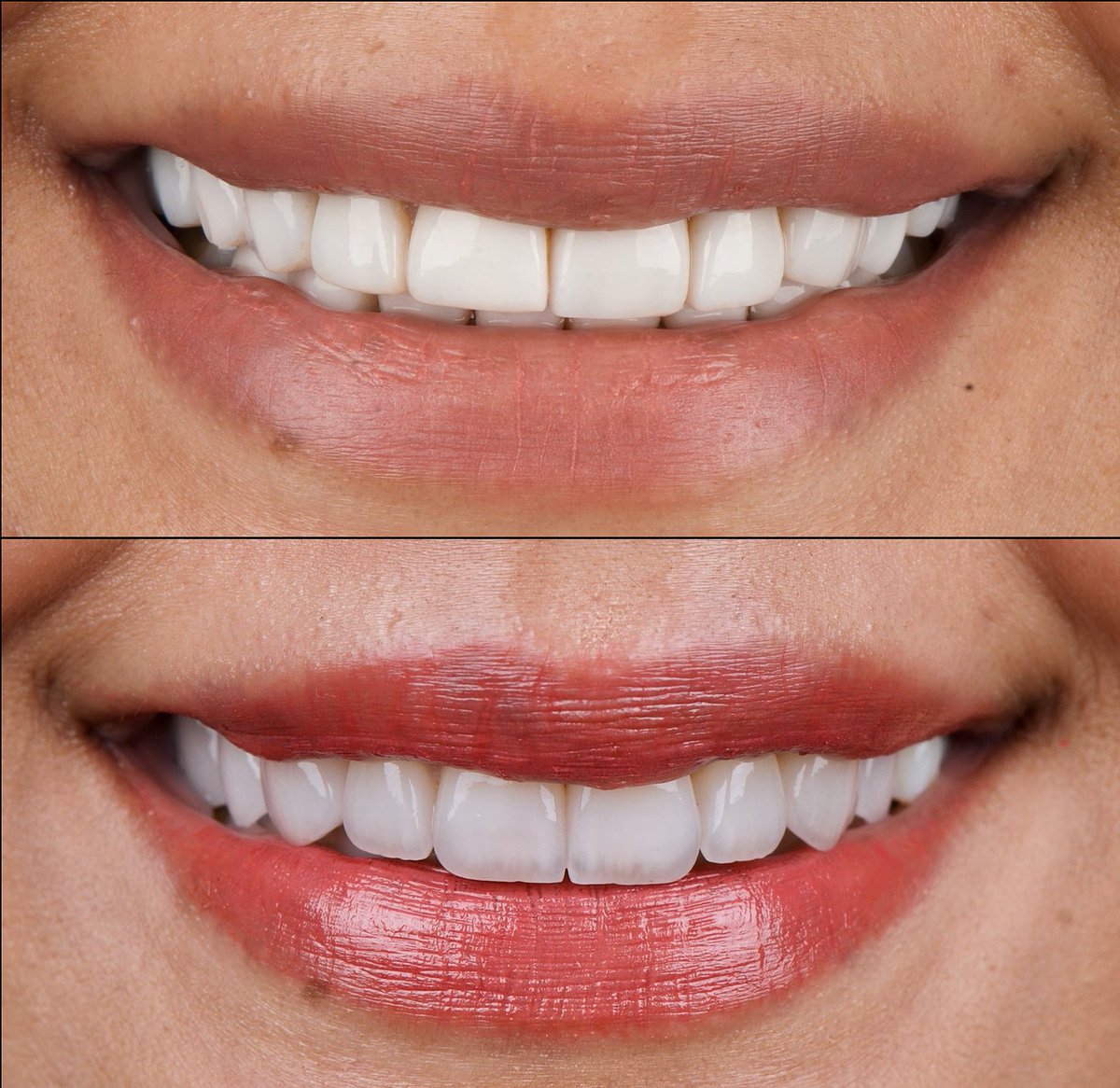 استبدال العدسات القديمة بعدسات اجمل وارتب وشكلها طبيعي  <a href="/dentalhousec/">Dental House Clinics</a>