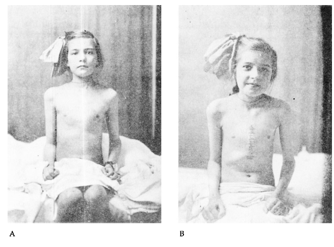 Mitrovalvology's tweet photo. In 1923, Elliot Carr Cutler done 1st mitral valve repair.
Mitral valve surgery 100th anniversary https://t.co/s5yADGxKWh
