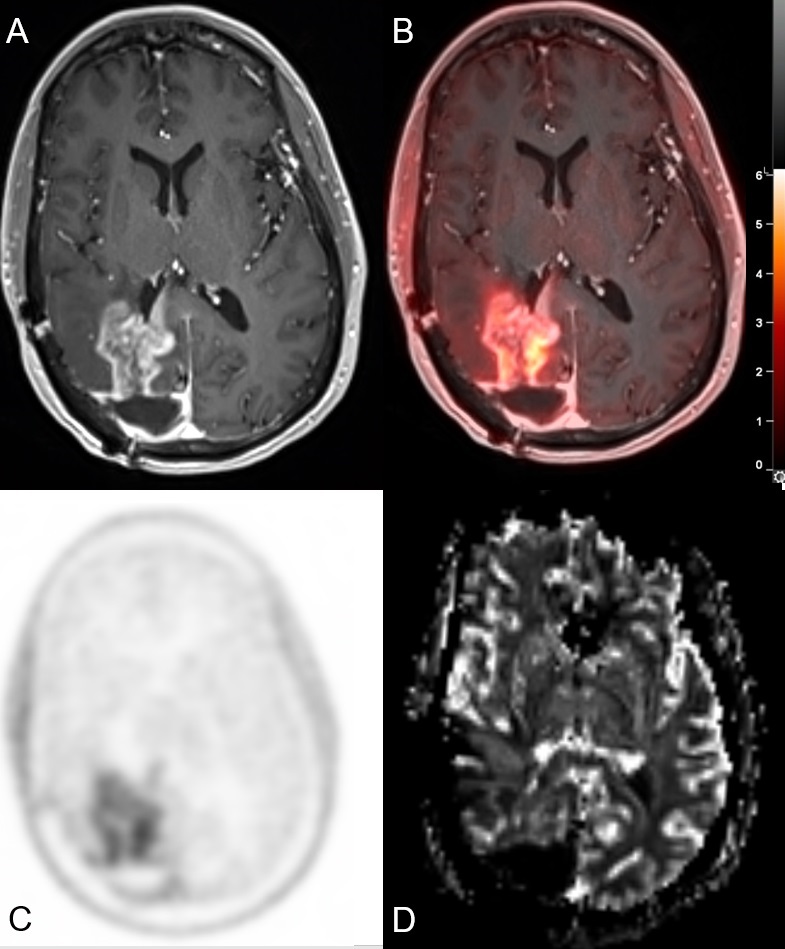 JournalofNucMed's tweet photo. Good idea and easily available; let’s go for indication approval and reimbursement! https://t.co/m1QHZrfC9h

#NuclearMedicine #PETscan #BrainCancer @Ali_Nabavizadeh @PennRadiology https://t.co/d47nLS0yHm