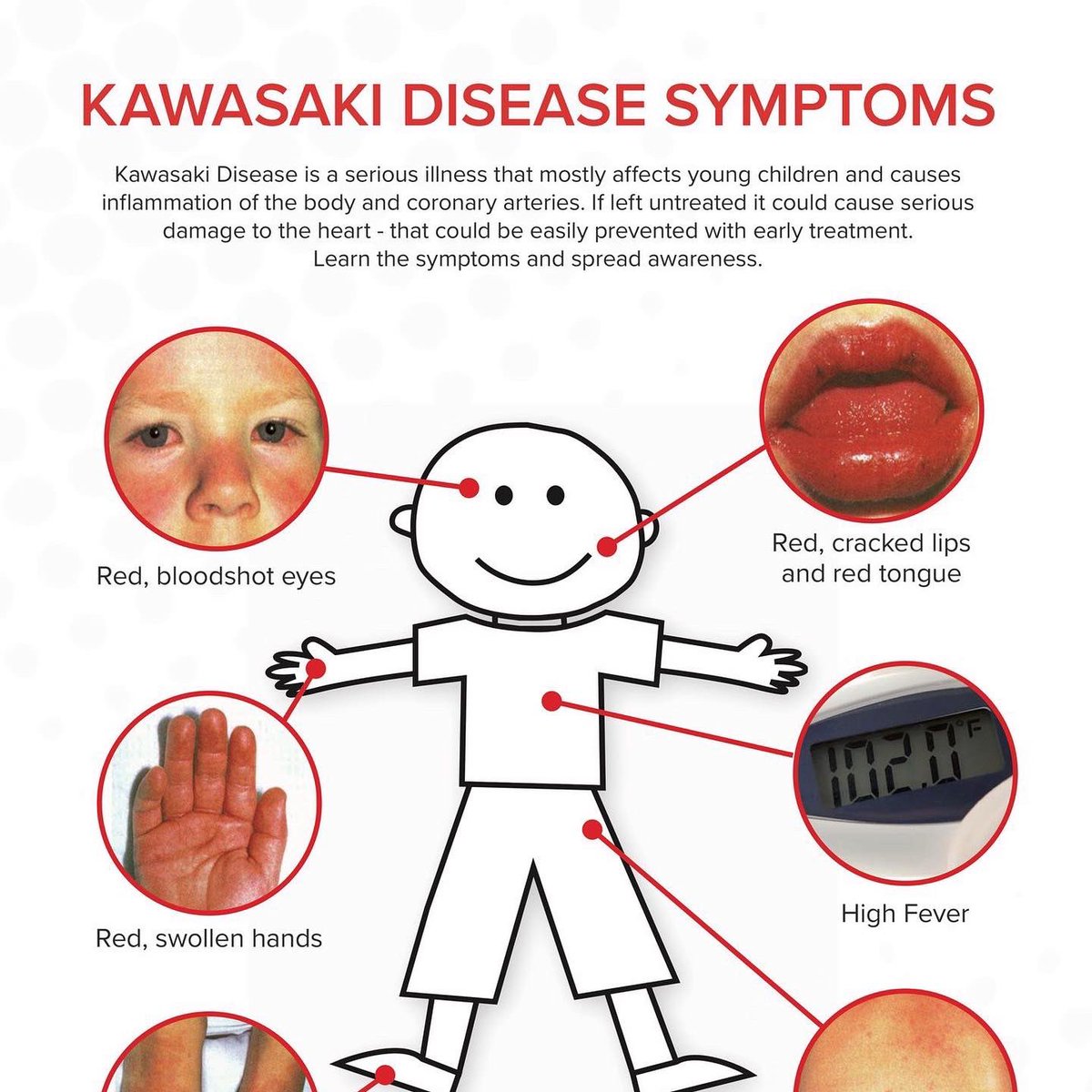 Day 2 of Kawasaki Disease Awareness Month

Over 10,000 of these KD Symptom postcards have been distributed across the country and you can order yours today.
Order some today at kawasakikidsfoundation.org/kawasaki-disea…
Let's all make a difference, educate, and grow awareness for Kawasaki Disease.