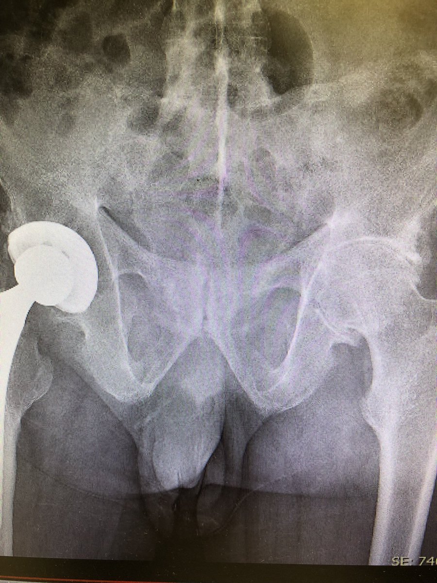 #ClinicalPearl. List 3 reasons why this pt has #ankylosing #spondylitis. Hint look beyond back.